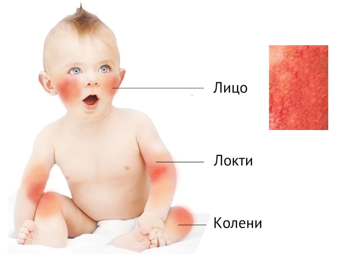Появление сыпи при аллергии на кефир