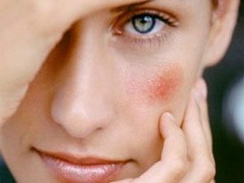 Какие капли в глаза можно использовать при аллергии при беременности?