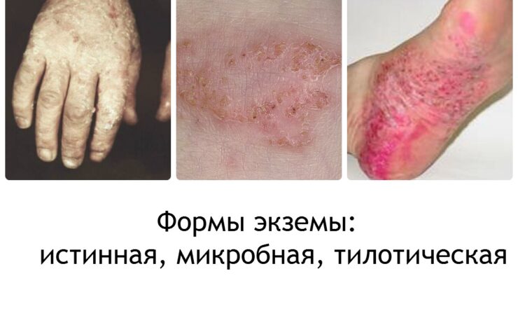 Симптомы и причины возникновения экземы