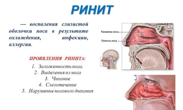 Симптомы и лечение вазомоторного аллергического ринита