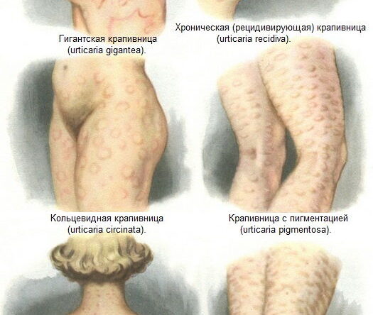 Крапивница: лечение традиционными и народными средствами
