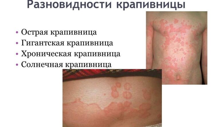 Меню при крапивнице для ребенка
